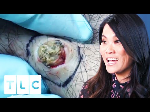 Dr Lee Squeezes A Cyst Through A Dilated Pore | Dr. Pimple Popper: This Is Zit