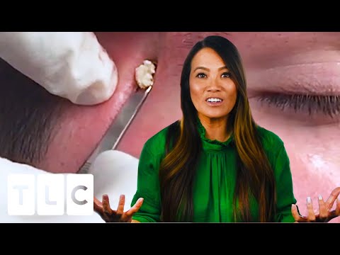 The Beautiful Blackheads | Dr Pimple Popper: This Is Zit